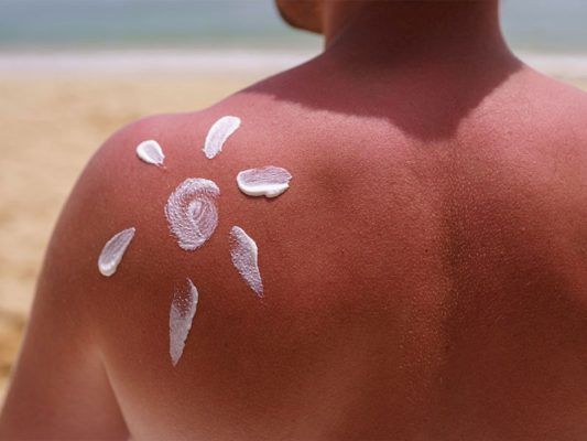 کرم ضد آفتاب بر روی پوست فردی که آفتاب سوخته شده است